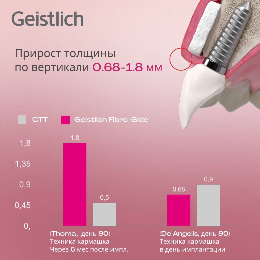 Утолщение мягких тканей при аугментации с применением матрикса Geistlich Fibro-Gide